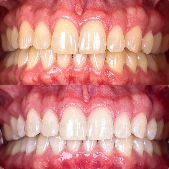 Antes y después de blanqueamiento dental Philips Zoom en Eudent — caso 1