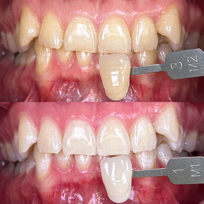Resultado de blanqueamiento de dientes Philips Zoom en Eudent — caso 2