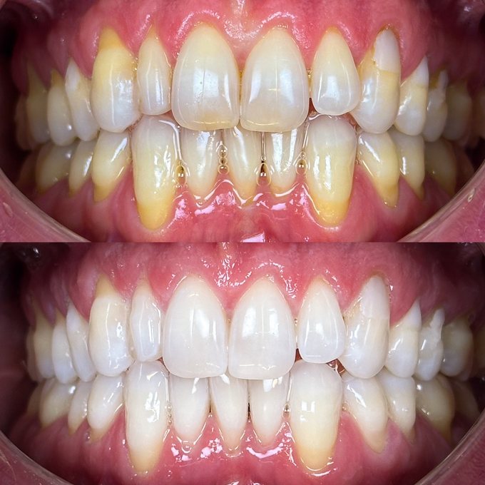 Antes y después de blanqueamiento dental en Eudent — caso 3