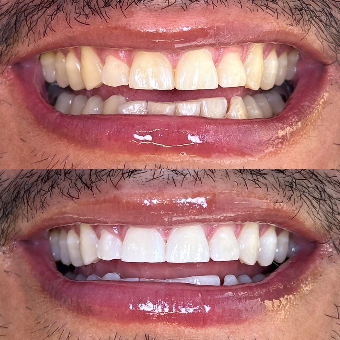 Blanqueamiento de dientes Philips Zoom, resultado real en Eudent — caso 4
