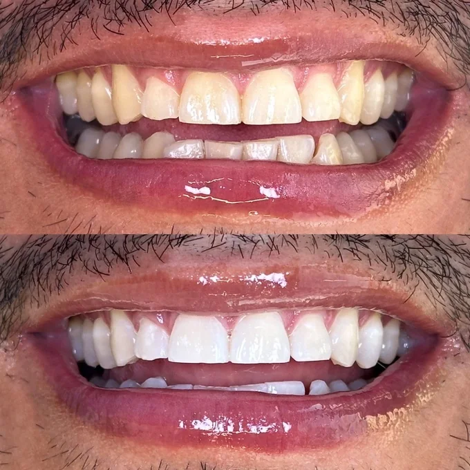 Resultado de ortodoncia en Eudent, antes y después